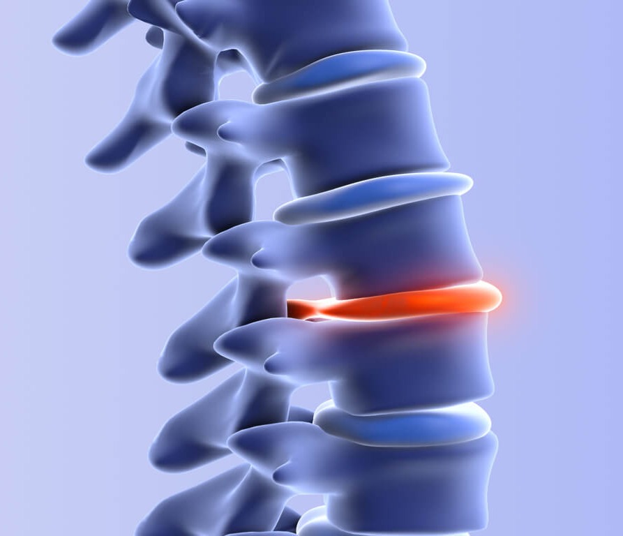 Herniated disc car accident nc