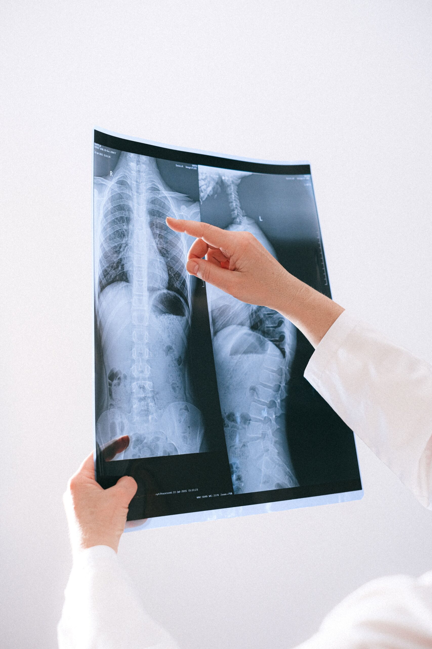 Doctor pointing at x-ray of a patient's spine
