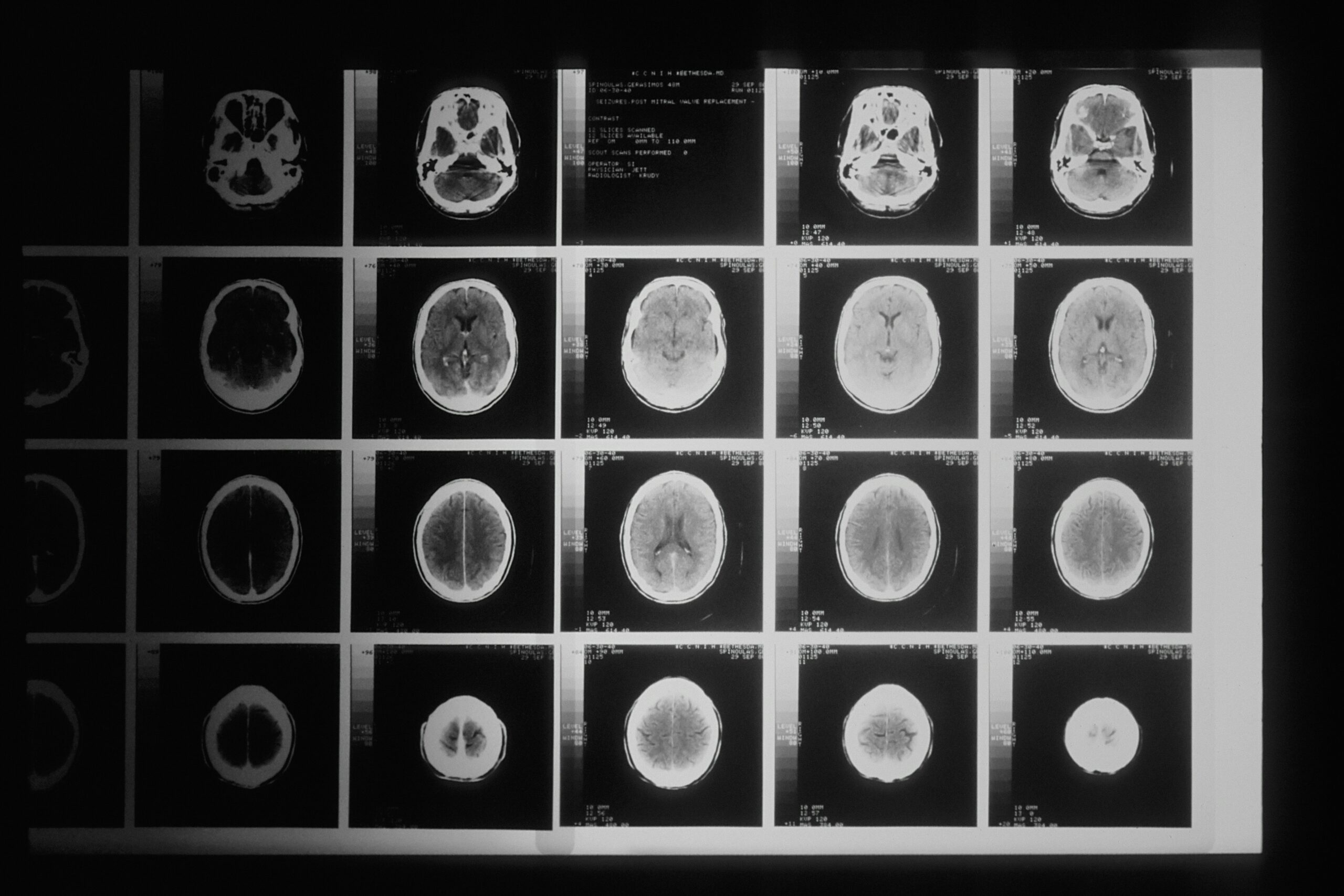 Image of brain injury scans
